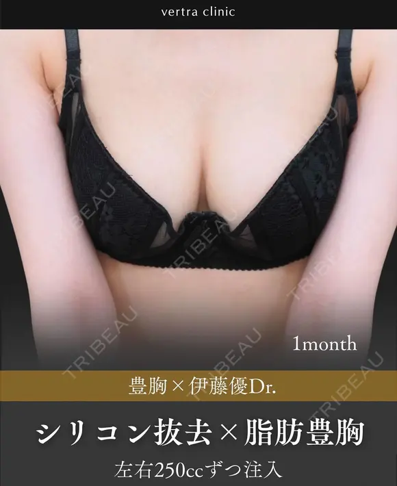 シリコン抜去+脂肪豊胸 before画像 メイン用