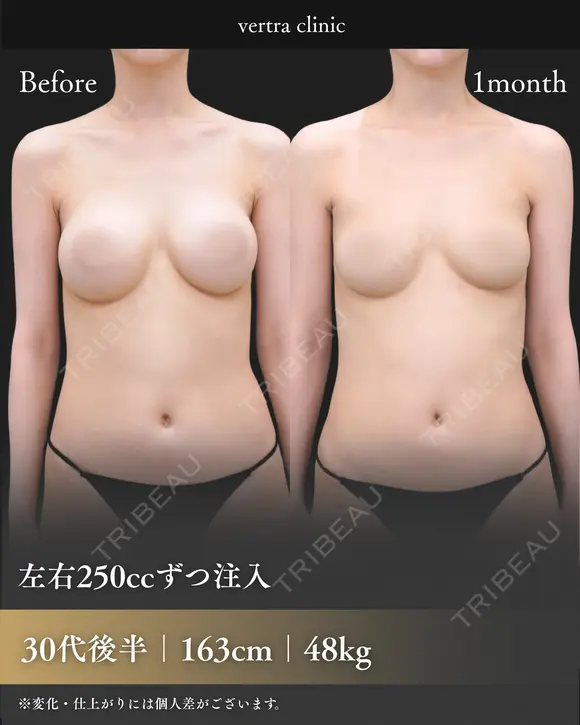 シリコン抜去+脂肪豊胸 30日後 メイン用