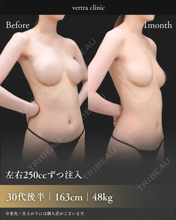 シリコン抜去+脂肪豊胸 30日後 メイン用