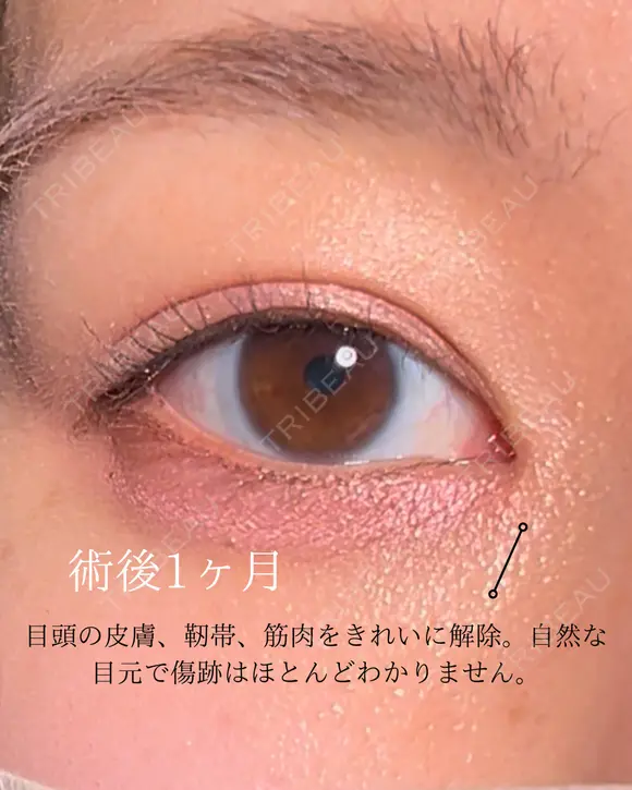 目頭切開 30日後 メイン用