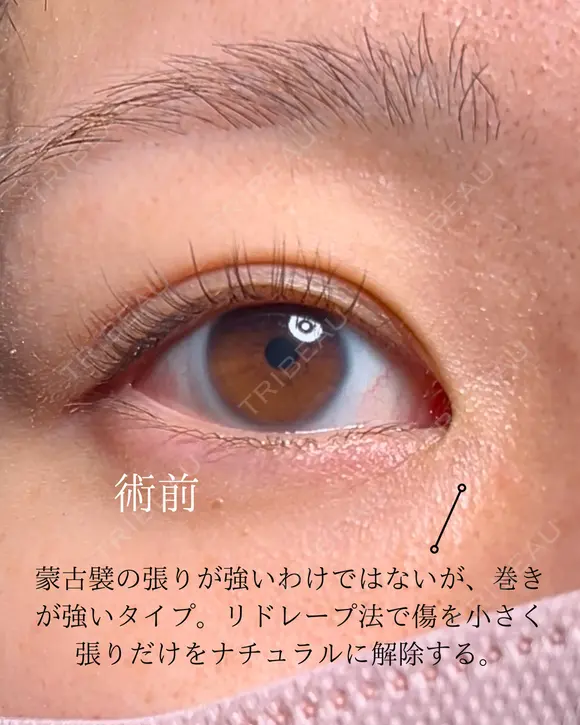 目頭切開 before画像 メイン用