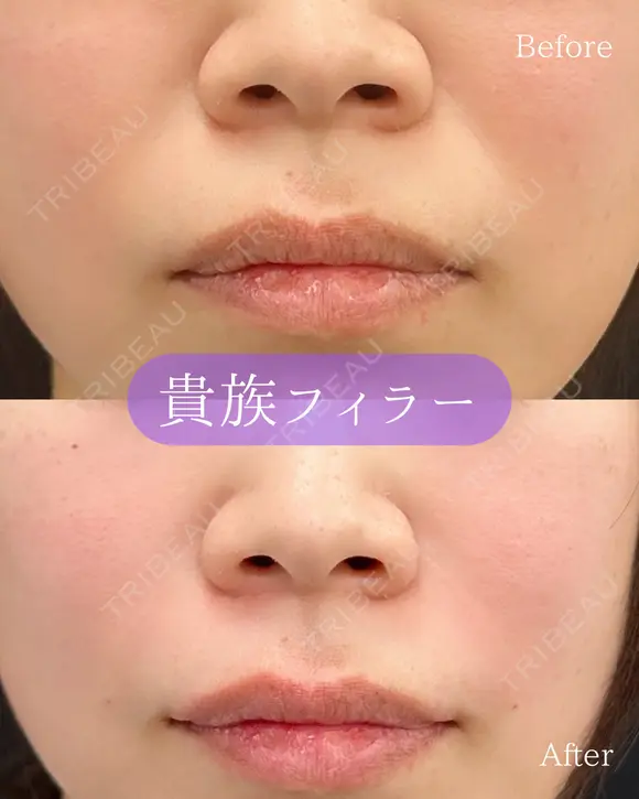 貴族フィラー(ボラックス) after画像 メイン用