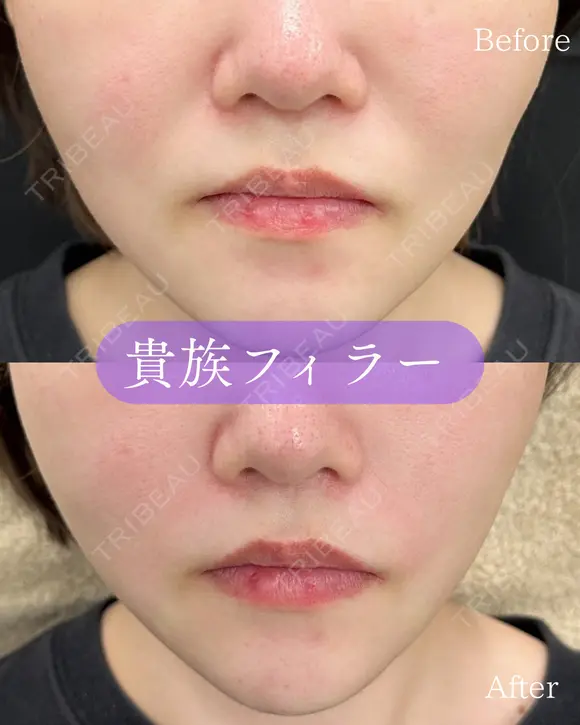 貴族フィラー(ボラックス) before画像 メイン用