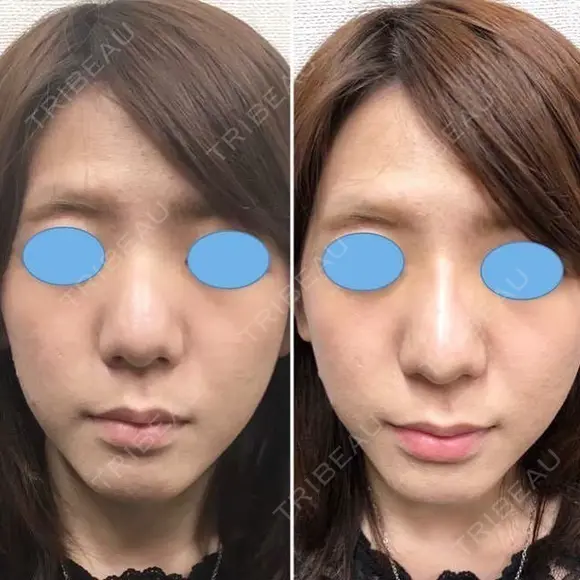 【女性】 蘇原しのぶ院長オリジナル鼻ヒアルロン酸 after画像 メイン用