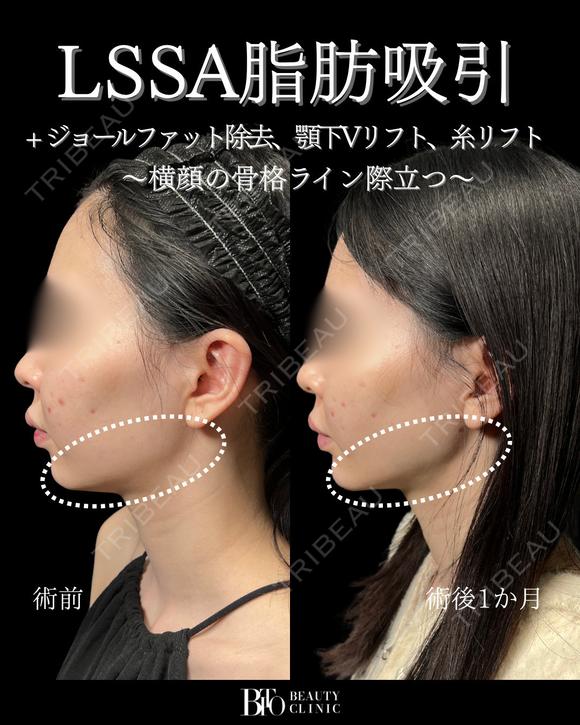 LSSA脂肪吸引(頬+顎下+ジョールファット)・糸リフト・顎下Vリフト after画像 メイン用