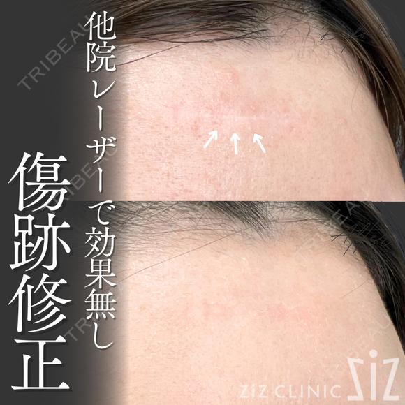 【傷跡修正】他院レーザーで効果なし after画像 メイン用