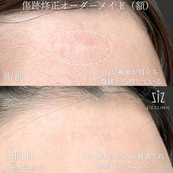 【傷跡修正】他院レーザーで効果なし before画像 メイン用