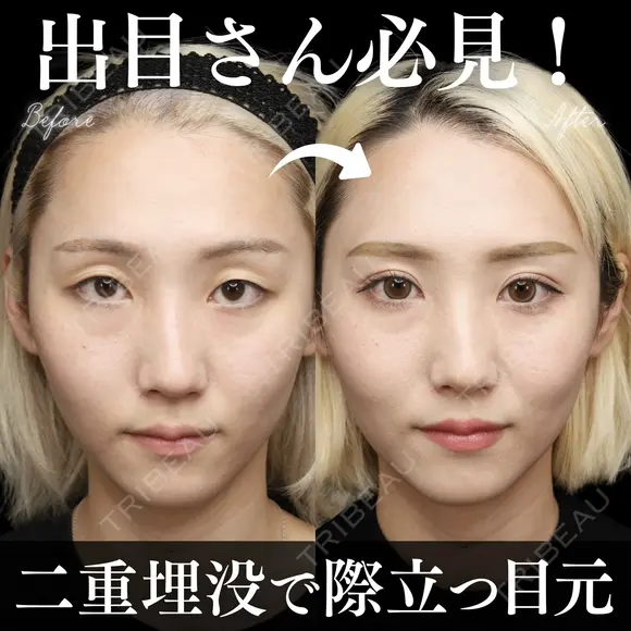 二重埋没法 30日後 メイン用