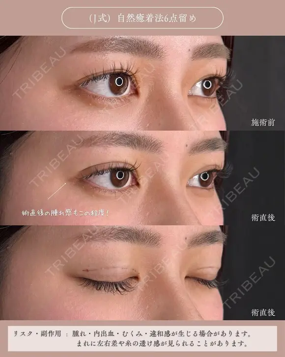 二重術（埋没法）（J式）自然癒着法6点留め before画像 メイン用