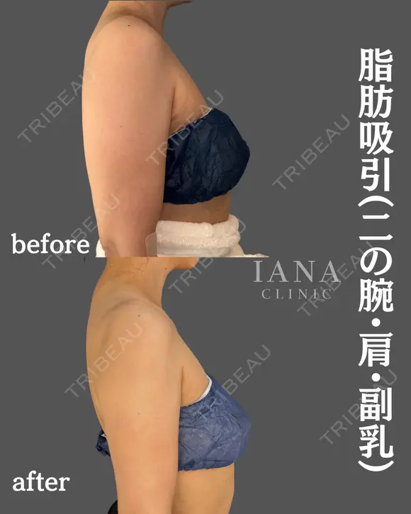 脂肪吸引(二の腕・肩・付け根・副乳・脇肉) before画像 メイン用