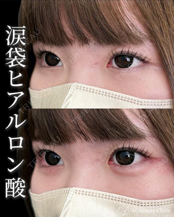 涙袋ヒアルロン酸 before画像 メイン用