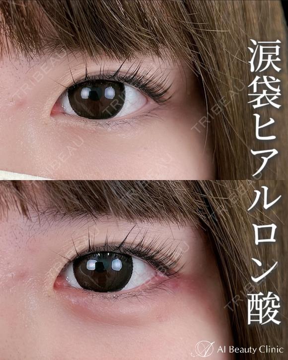 涙袋ヒアルロン酸 after画像 メイン用