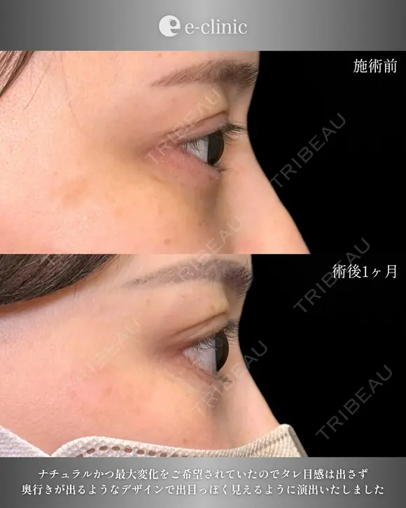 タレ目形成×目尻切開 30日後 メイン用