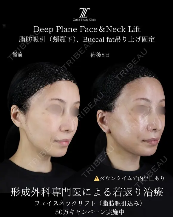 フェイスリスト５０万〜 after画像 メイン用