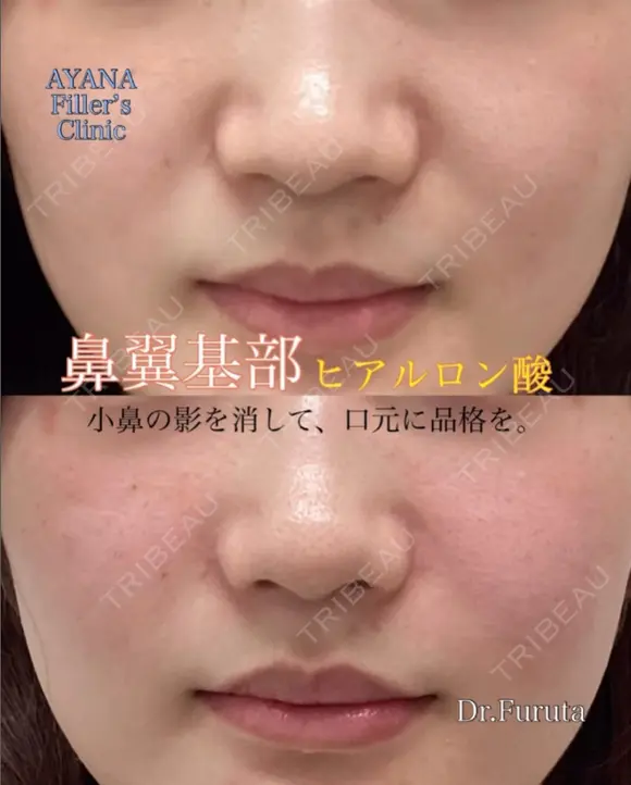 鼻翼基部ヒアルロン酸	 after画像 メイン用