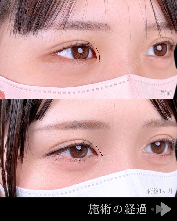 MD式目頭切開 before画像 メイン用