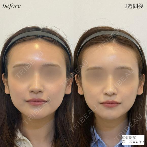額ヒアルロン酸 before画像 メイン用