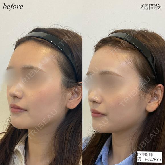 額ヒアルロン酸 after画像 メイン用