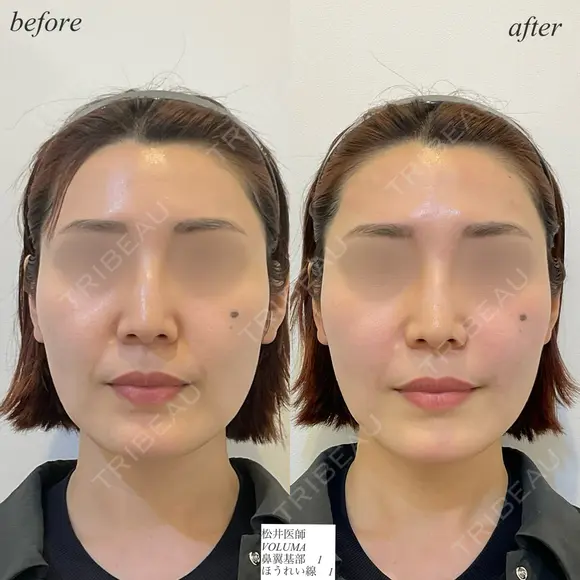 鼻翼基部　ほうれい線ヒアルロン酸 before画像 メイン用