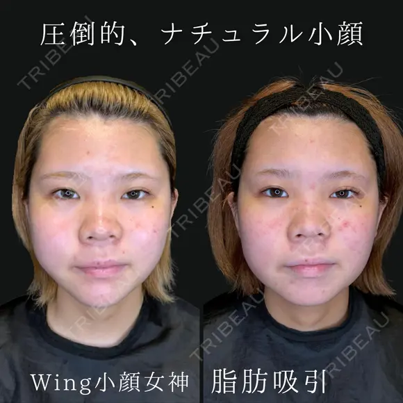 Wing小顔女神脂肪吸引 30日後 メイン用