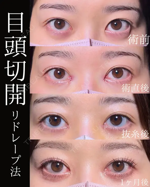 目頭切開 30日後 メイン用