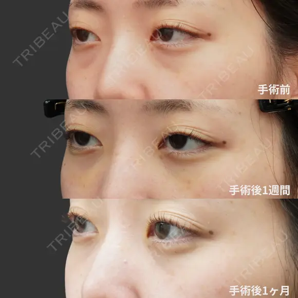 経結膜脱脂術＋眼窩脂肪注入 before画像 メイン用