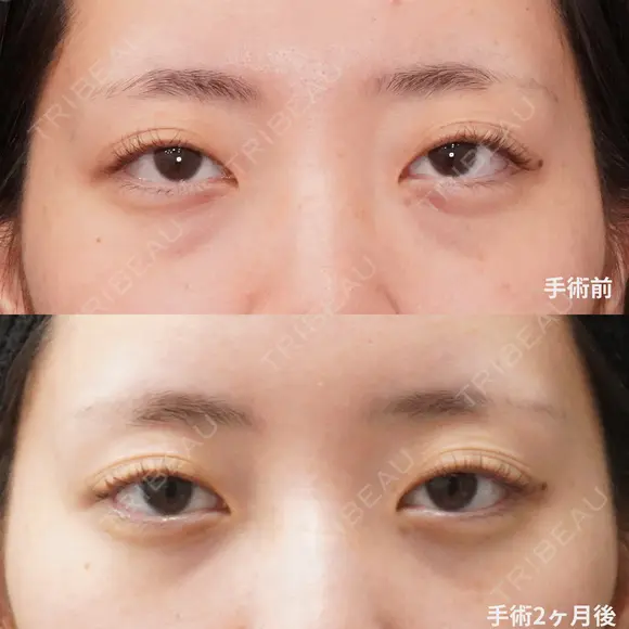 経結膜脱脂術＋眼窩脂肪注入 2日後 メイン用