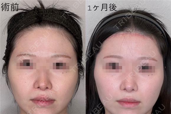 額リフト before画像 メイン用