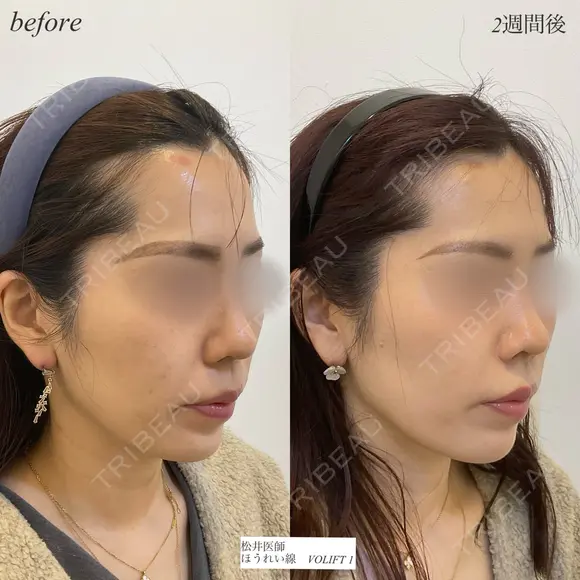 ほうれい線ヒアルロン酸 after画像 メイン用