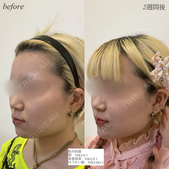 カスタマイズヒアルロン酸 after画像 メイン用