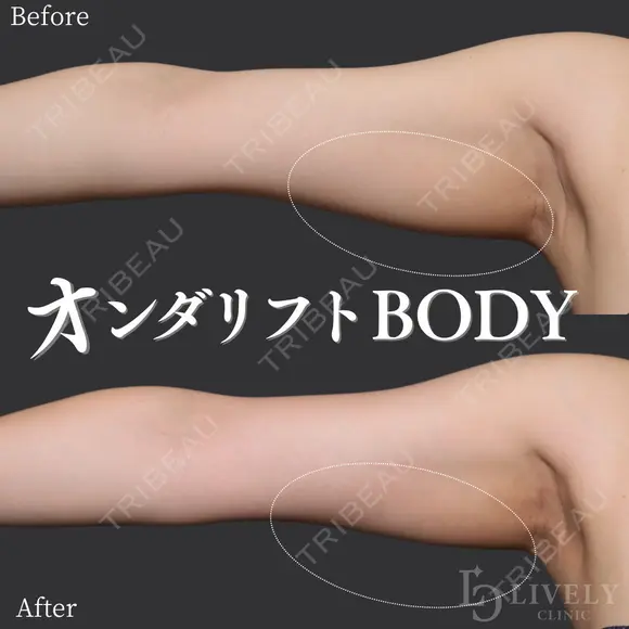 オンダリフトボディ before画像 メイン用