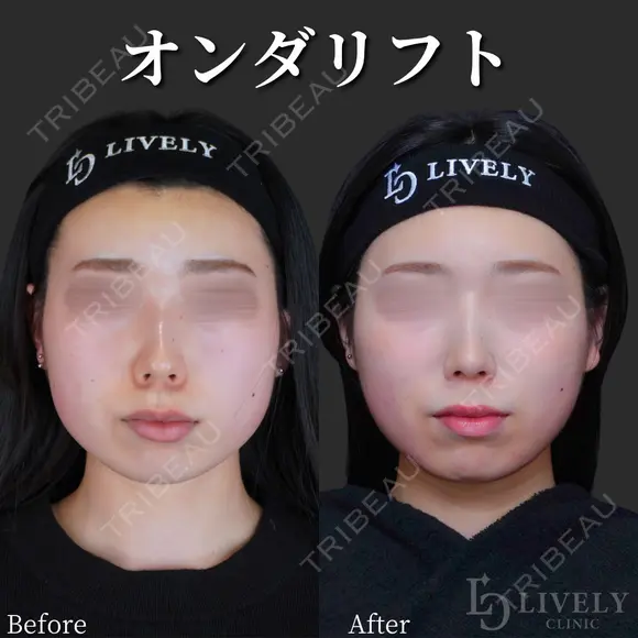 オンダリフト after画像 メイン用