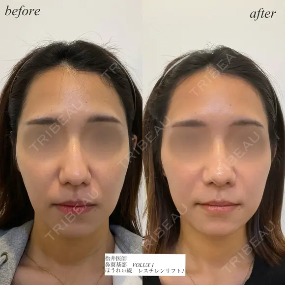 鼻翼基部ほうれい線ヒアルロン酸 before画像 メイン用