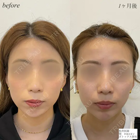 顎ヒアルロン酸　ボトックス before画像 メイン用
