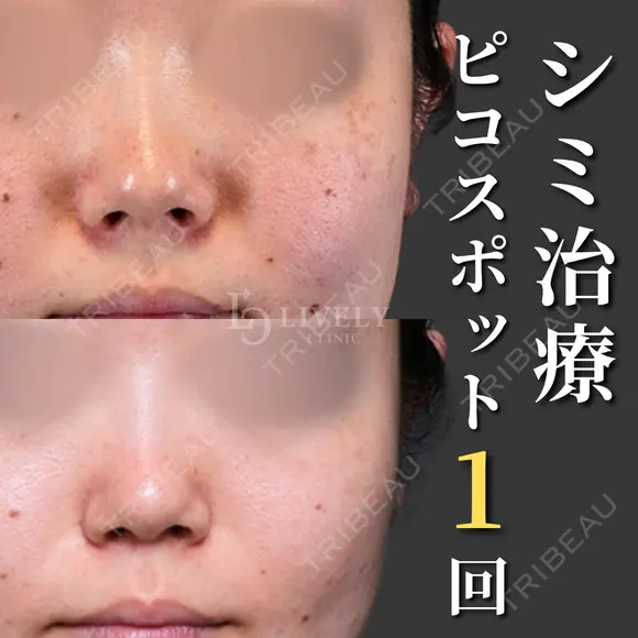 ピコスポット/シミ治療1回 before画像 メイン用