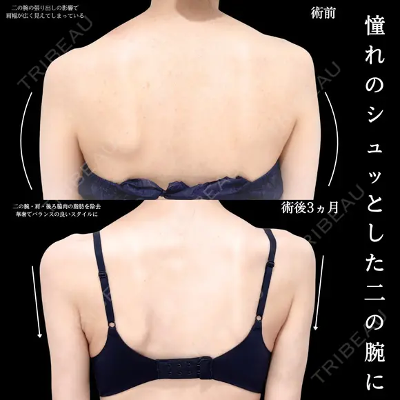 二の腕　肩　脂肪吸引 90日後 メイン用