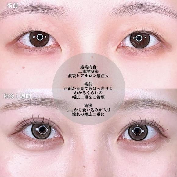 アリエルクイックループトリプル二重埋没法 before画像 メイン用