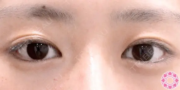 ♡二重埋没法 before画像 メイン用