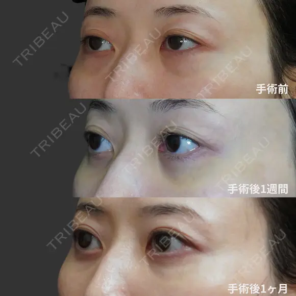 経結膜脱脂術 before画像 メイン用