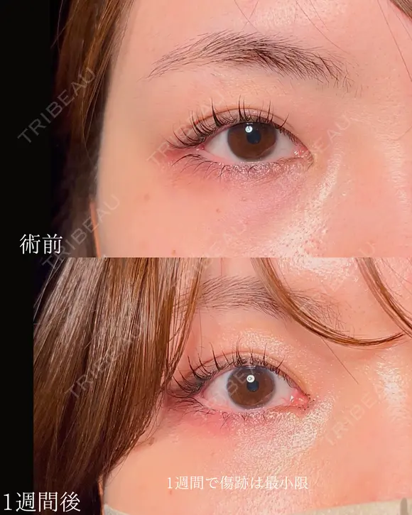 目頭切開 7日後 メイン用