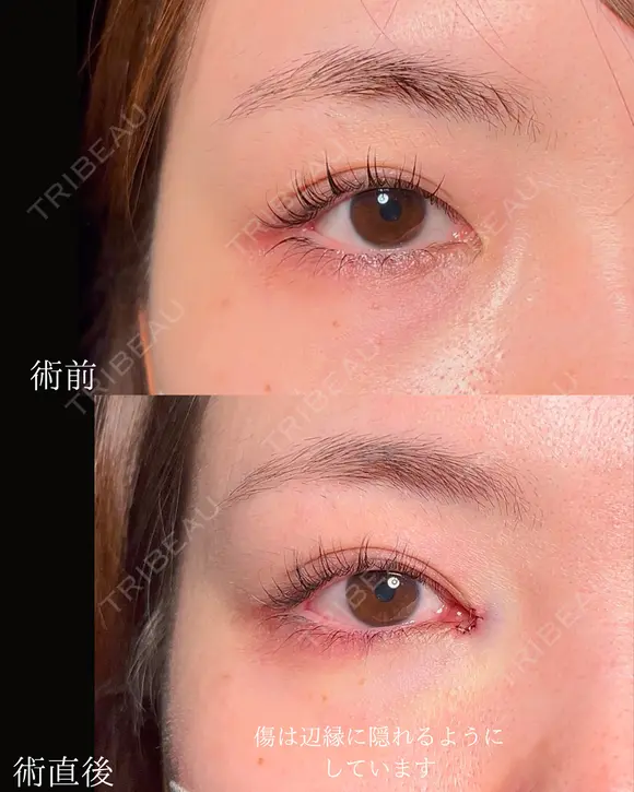 目頭切開 before画像 メイン用