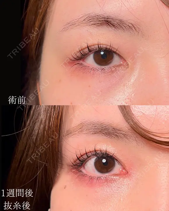 目頭切開 7日後 メイン用