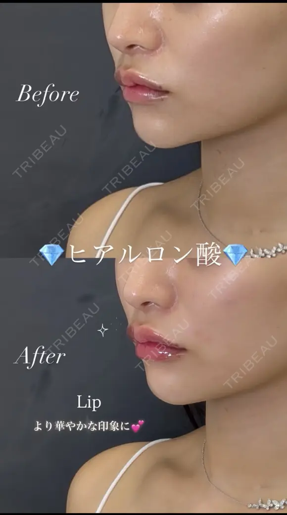 【リップ】ヒアルロン酸注入 before画像 メイン用