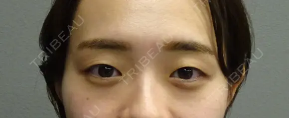 二重埋没・2点留め before画像 メイン用