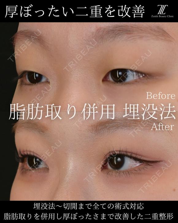 脂肪取り併用　埋没法 after画像 メイン用