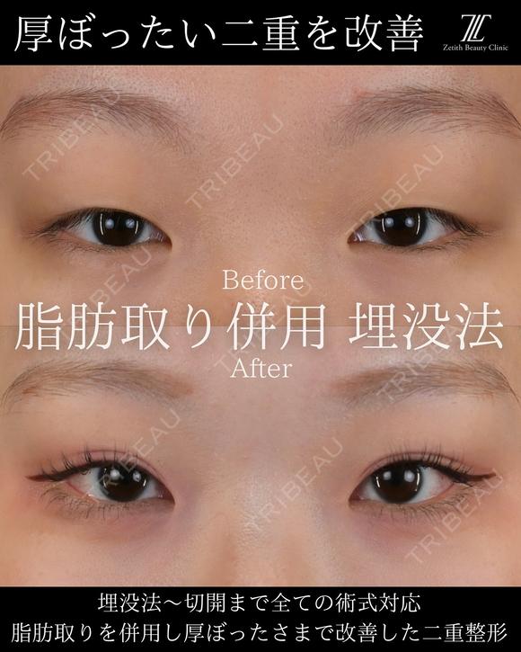 脂肪取り併用　埋没法 after画像 メイン用