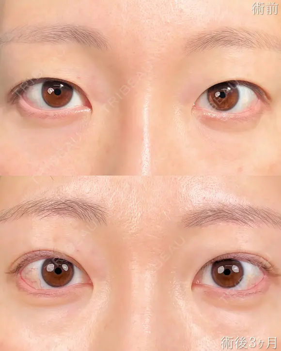 🧡眉下切開(切開リフト)🧡 90日後 メイン用