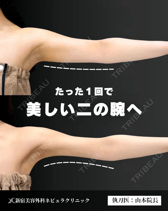 【二の腕】の脂肪吸引🧡 after画像 メイン用