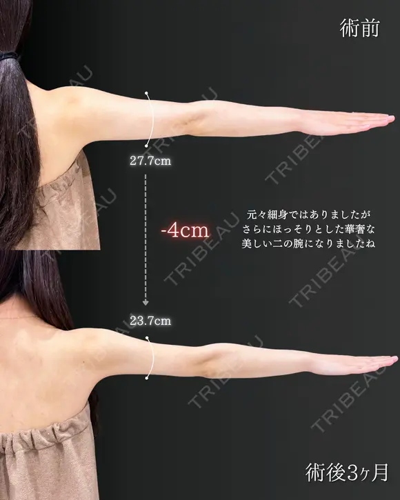 【二の腕】の脂肪吸引🧡 after画像 メイン用