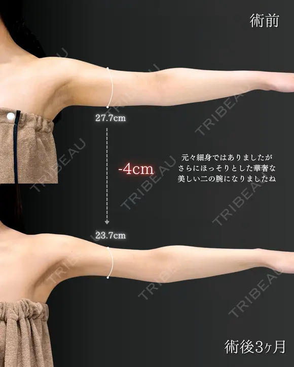 【二の腕】の脂肪吸引🧡 after画像 メイン用